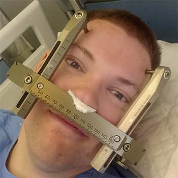 diepteregistratie ervaring stereotactisch frame