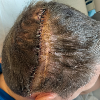 epilepsiechirurgie ervaring schedel