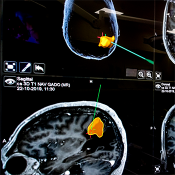 epilepsiechirurgie ervaring monitor