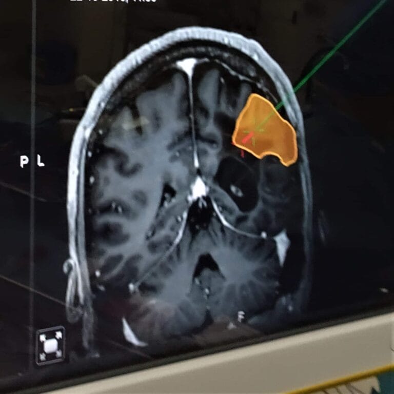 Epilepsie en de risico’s bij een operatie mijn ervaring
