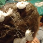 Elektroden Stereo EEG in de hersenen voor mogelijke epilepsiechirurgie